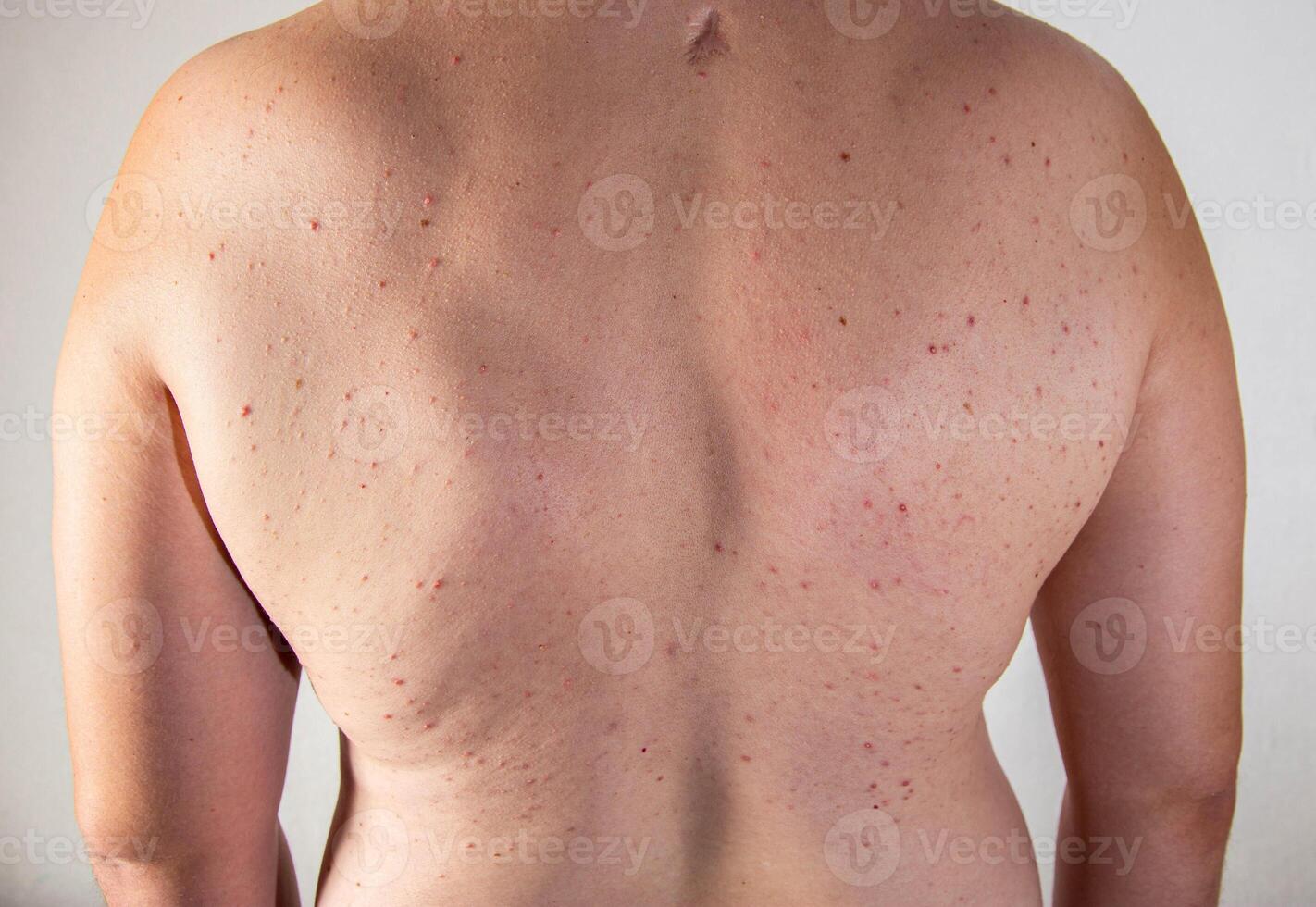 Red pimples on a man's back. Skin irritation and allergy concept. Diseases of the gastrointestinal tract, close-up photo
