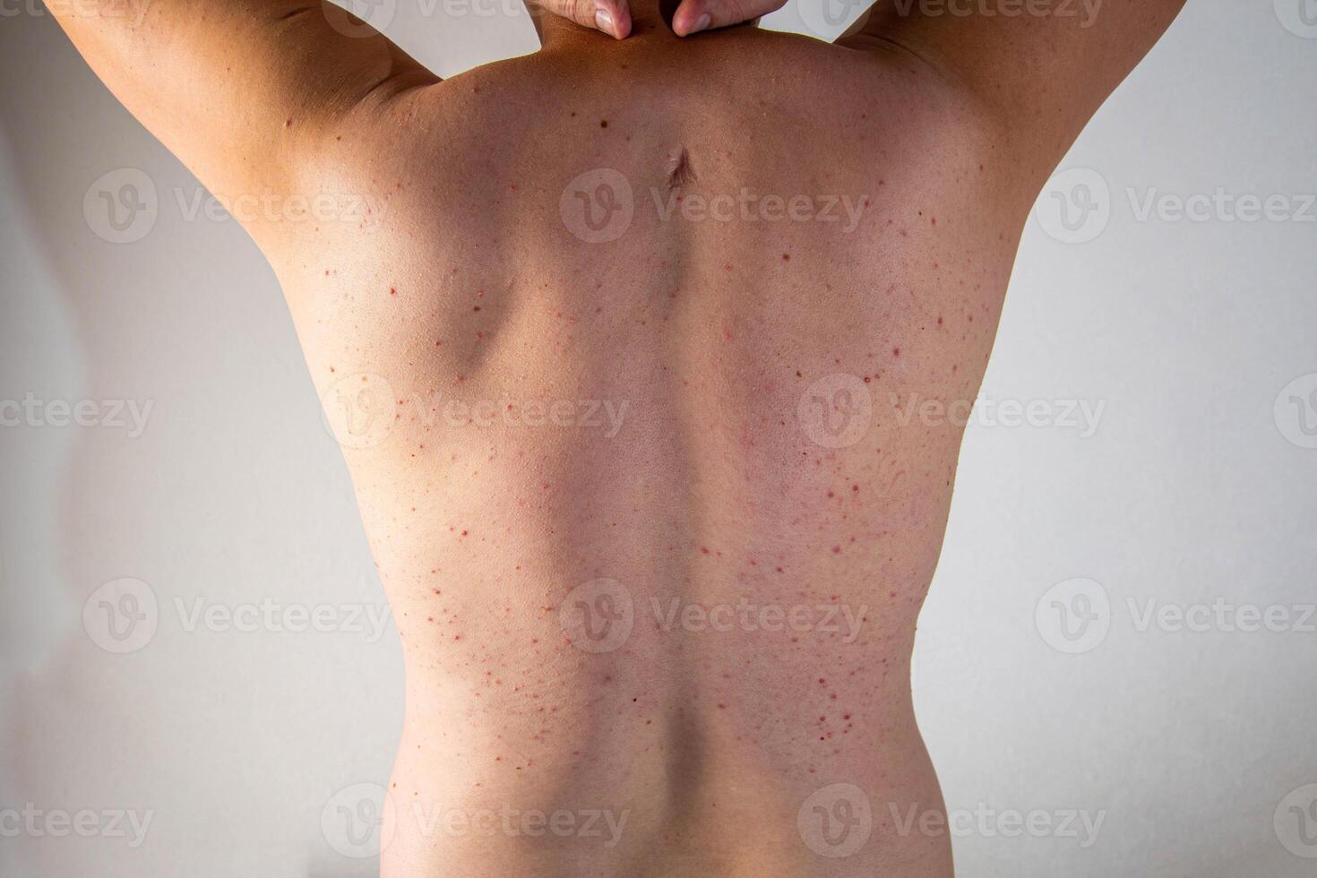 A man has a scar and red pimples on his skin due to poor hygiene. Inflammation of the sebaceous glands, close-up photo