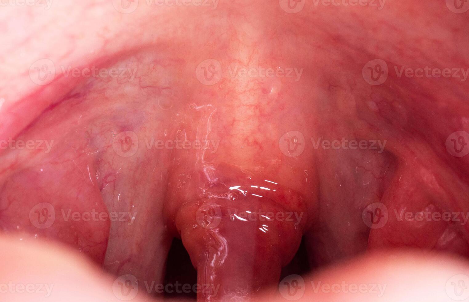 Uvulitis and sore throat in the oral cavity due to illness. Inflammation of the uvula and tonsils due to infections during illness, close-up, streptococcus photo