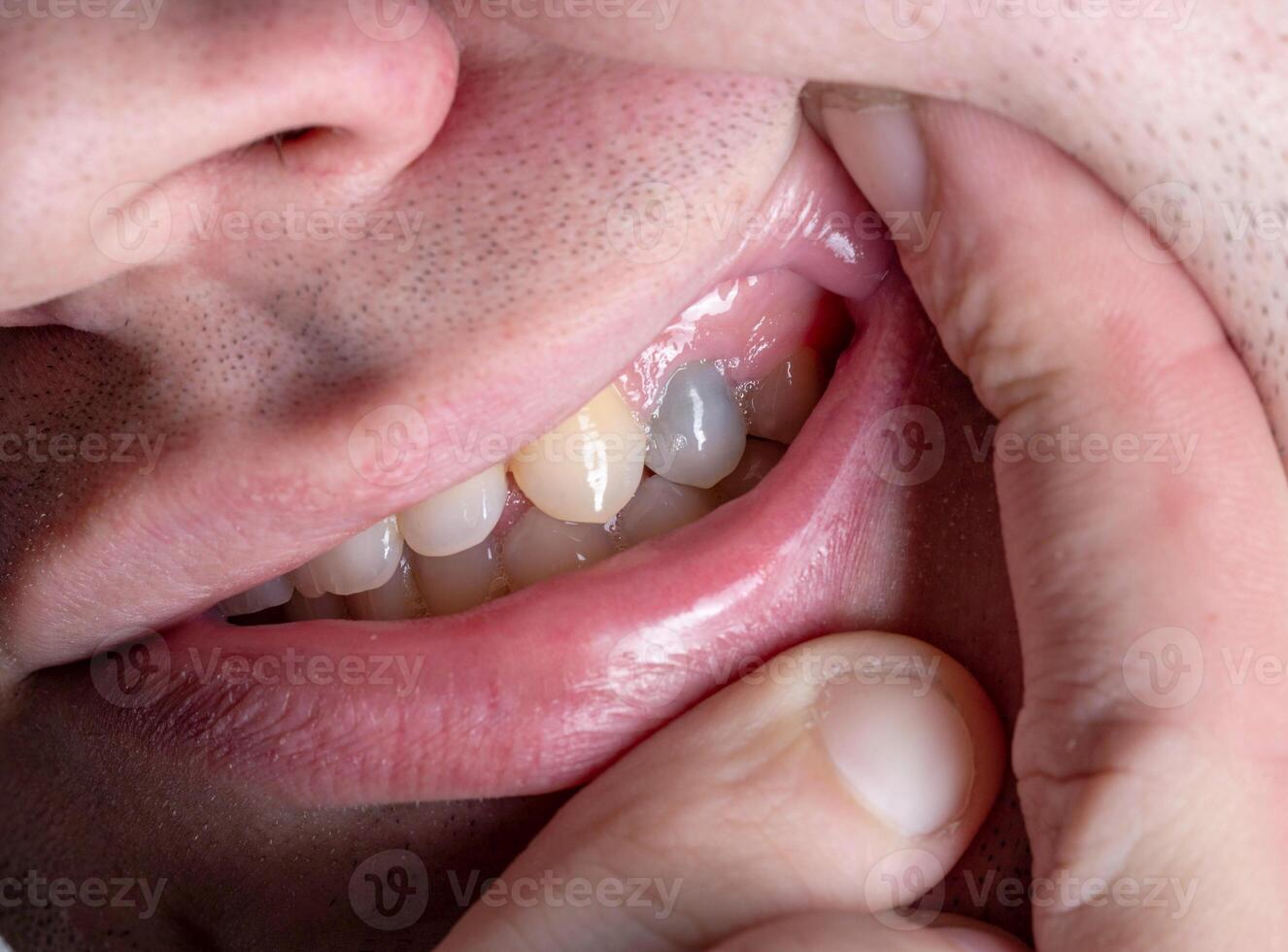 A dark tooth in a man's mouth after injury. Tooth decay by caries, dentistry. Macro photo