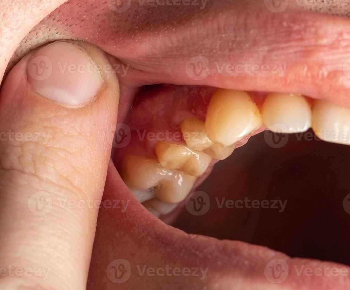 Ground prepared teeth before installing a porcelain fused-to-metal crown for decayed teeth. Prosthetics in dentistry, macro photo