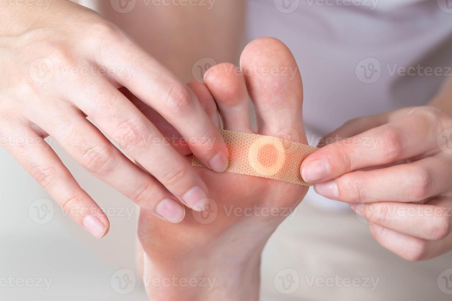 Woman sticks a medical plaster to the plantar wart of the leg to remove dead skin and calluses, close-up photo