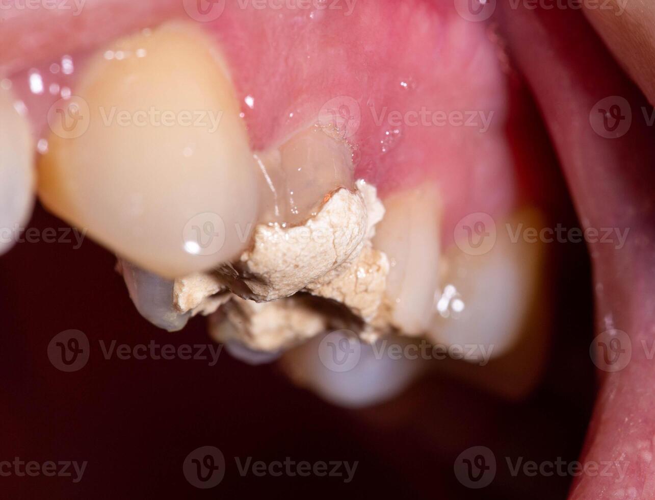 Installation of a temporary filling in the treatment of tooth canals, endodontics. Tooth pulpitis in dentistry, macro photo