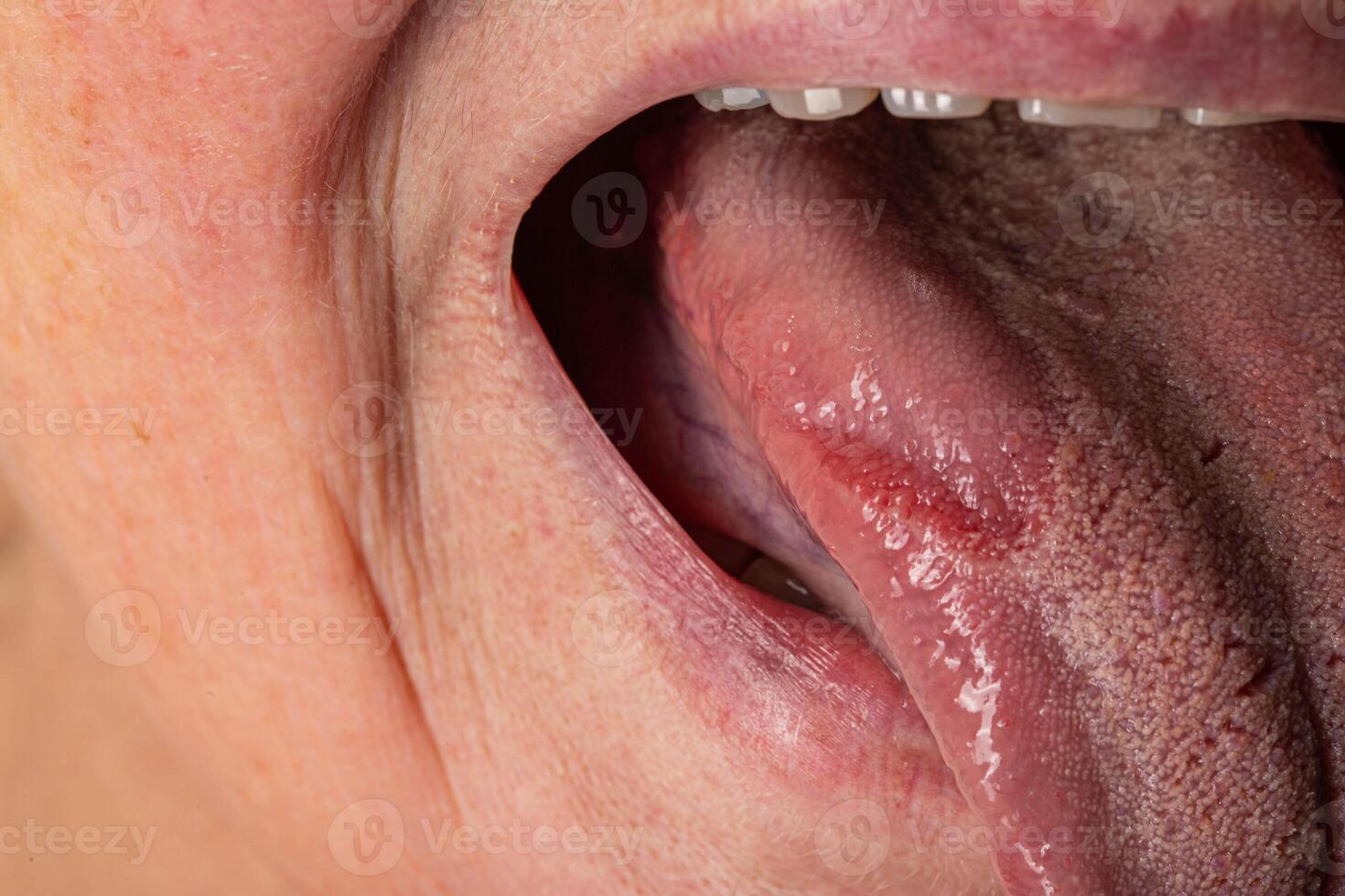 Inflammatory disease in the tongue. Red spot, glossitis. Hygiene of the tongue, close-up. Symptom of vitamin deficiency and bacteria photo