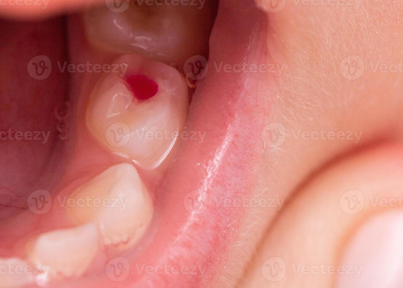 Installation of a colored red filling in a milk tooth for a child. Colored fillings in dentistry for children. Treatment of pulpitis and deep caries, close-up photo