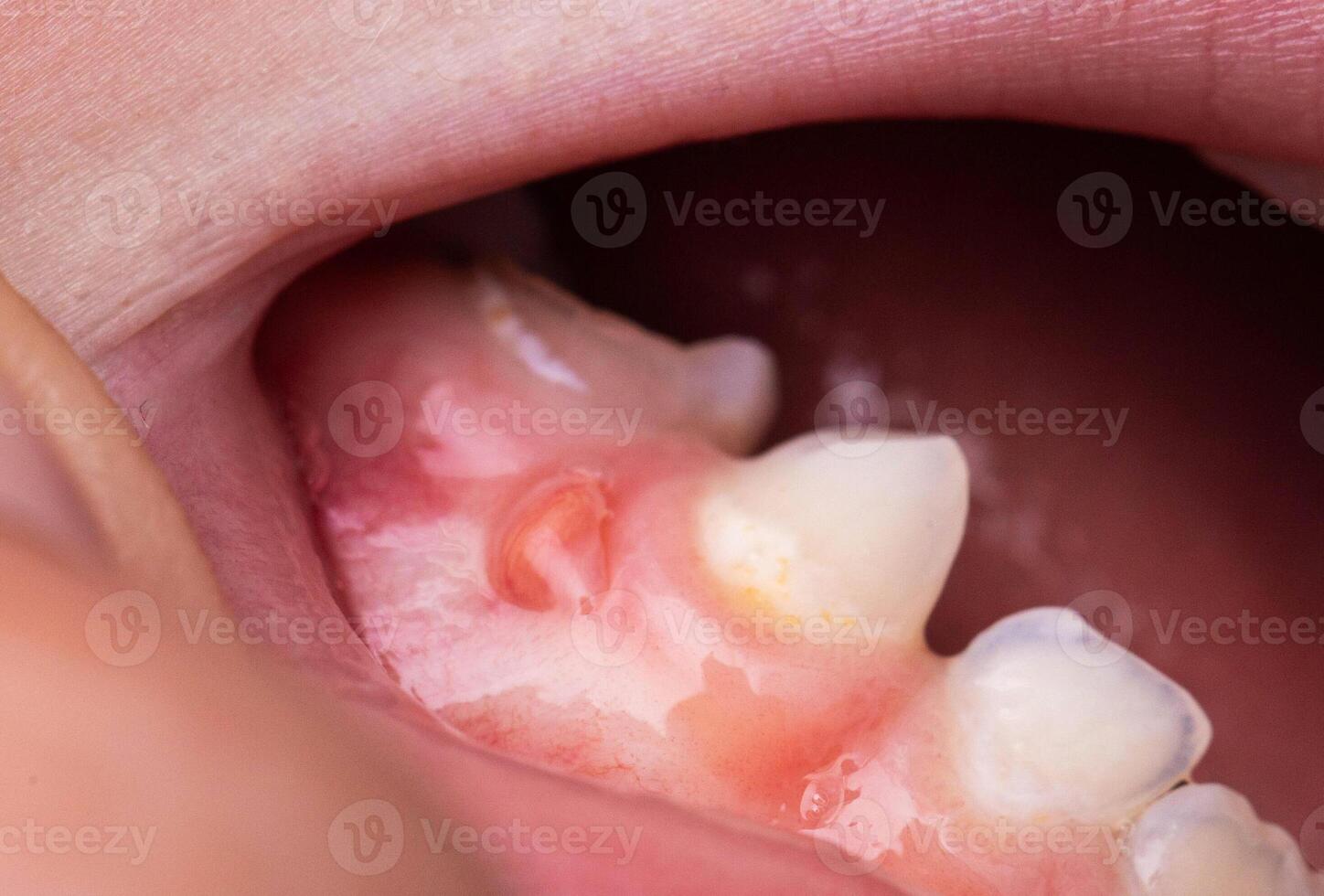 A bump is a tumor on the tooth gum in a child. Periodontitis in children due to a tooth with pulpitis. Close-up photo