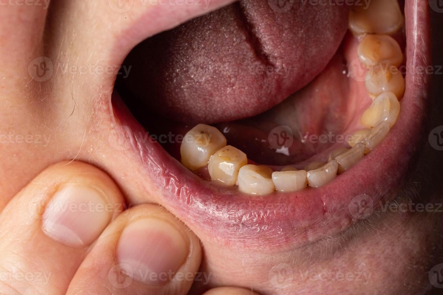 Crowned teeth. Preparation of teeth in dentistry for the installation of prostheses. Macro photo
