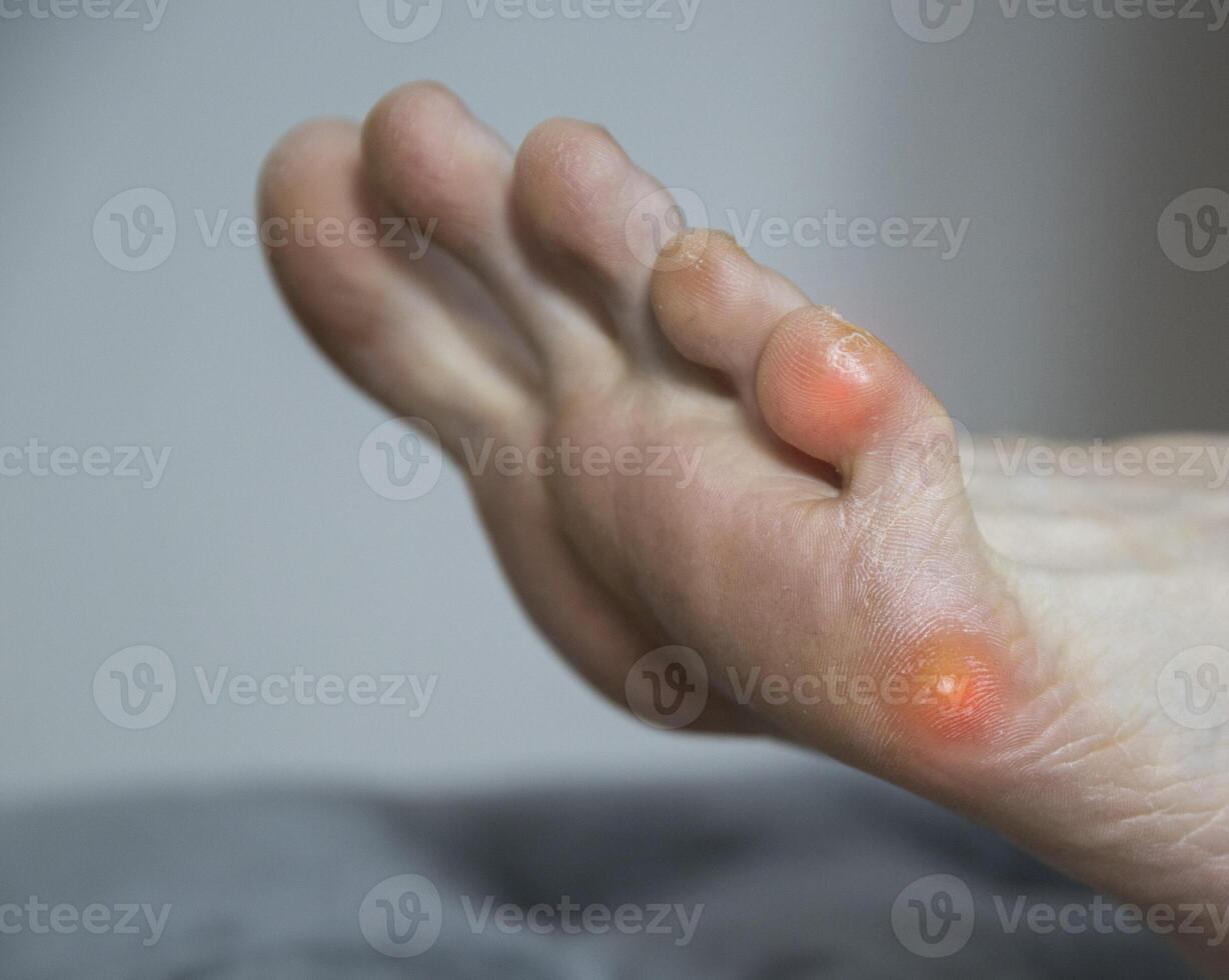 Plantar wart on the foot and little toe in humans. Treatment and removal of warts on the sole in dermatology. Copy space for text photo
