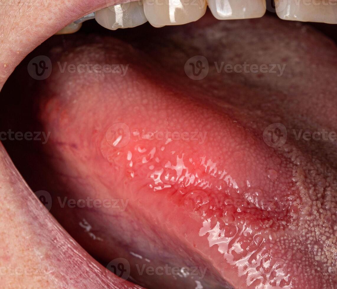 Inflammatory disease in the tongue. Red spot, glossitis. Hygiene of the tongue, close-up. Symptom of vitamin deficiency and bacteria photo
