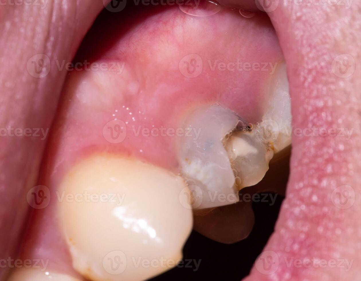 Chipped piece of a dead pulp tooth. Restoration of a damaged tooth in dentistry, defect in tooth enamel, thin tooth walls. Macro photo