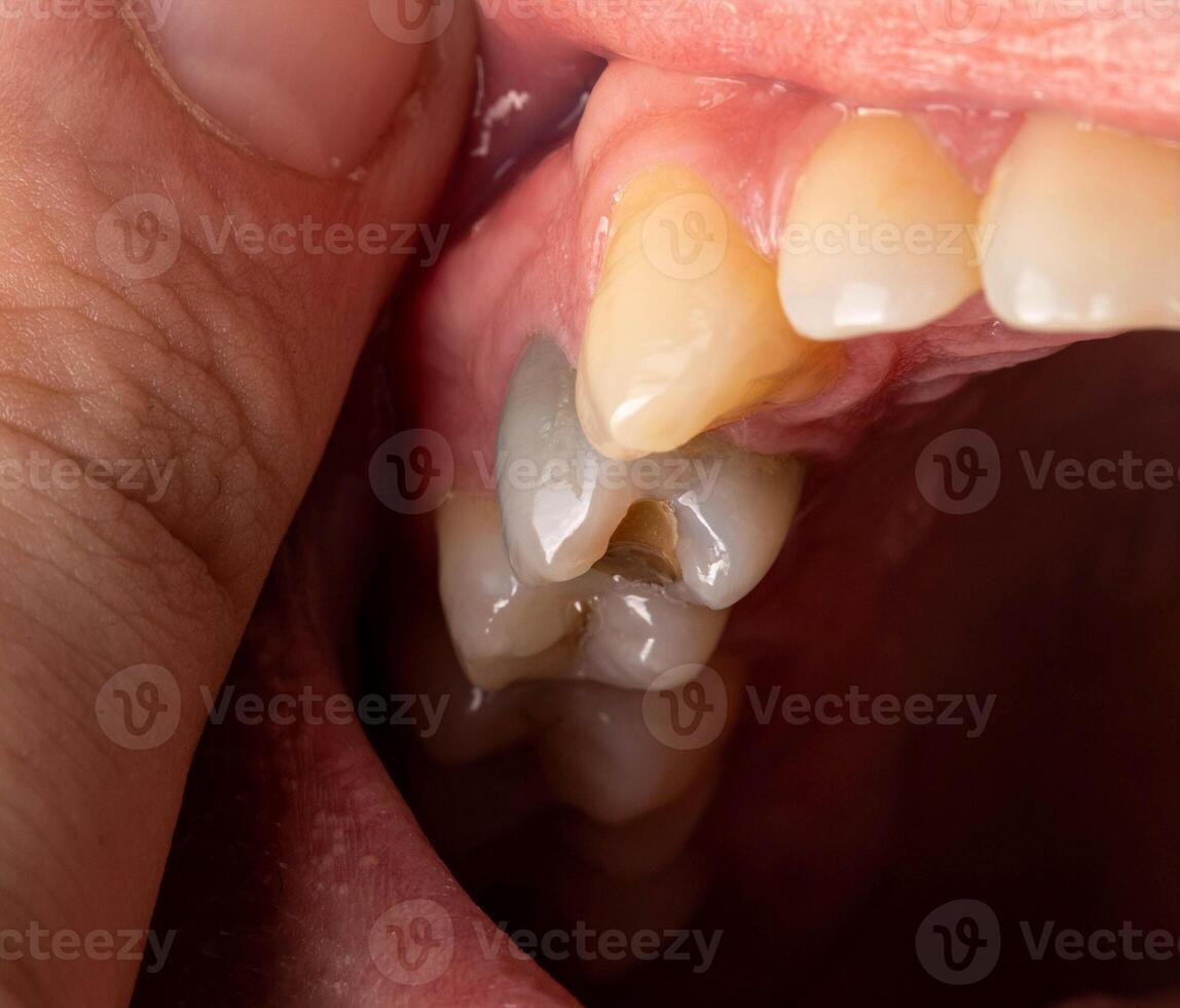 A black tooth in a man's mouth after removal of a nerve and filling of dental canals with low-quality materials. Tooth whitening, close-up photo