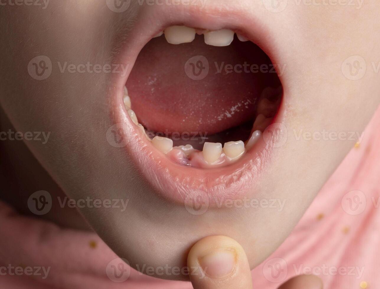 The open mouth of a child without one tooth. Loss of milk teeth. Close-up, deciduous teeth photo