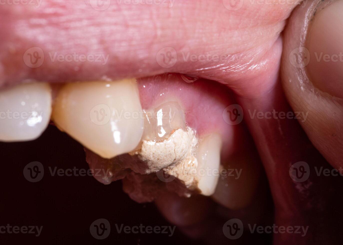 Tooth filling with temporary cement for root canal treatment. Tooth nerve removal, preparation for prosthetics, macro photo