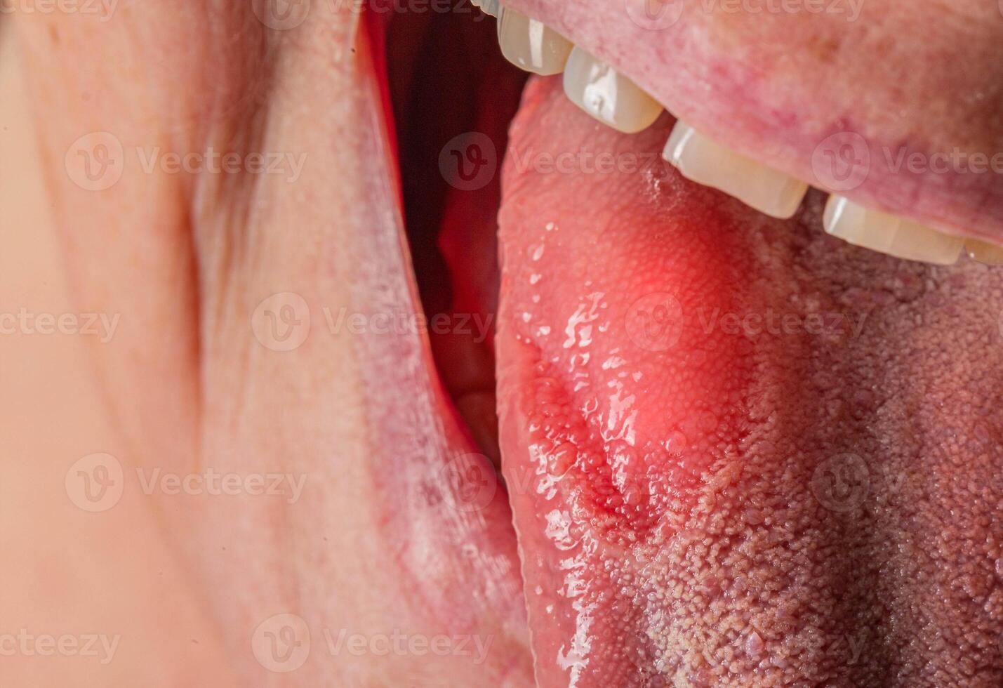Inflammatory disease in the tongue. Red spot, glossitis. Hygiene of the tongue, close-up. Symptom of vitamin deficiency and bacteria photo