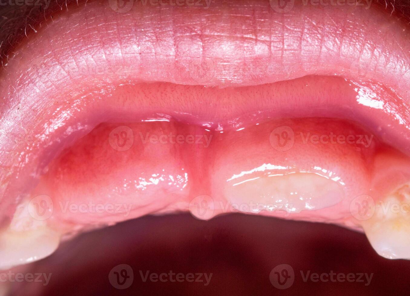 The eruption of a permanent tooth after the loss of a milk tooth in a child, close-up. Children's dentistry. photo