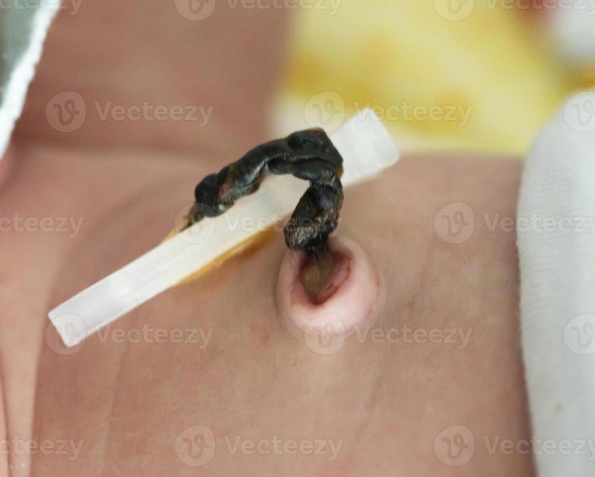 The remains of the umbilical cord in a baby after birth. Healing of the umbilical wound and umbilical ring, close-up. photo