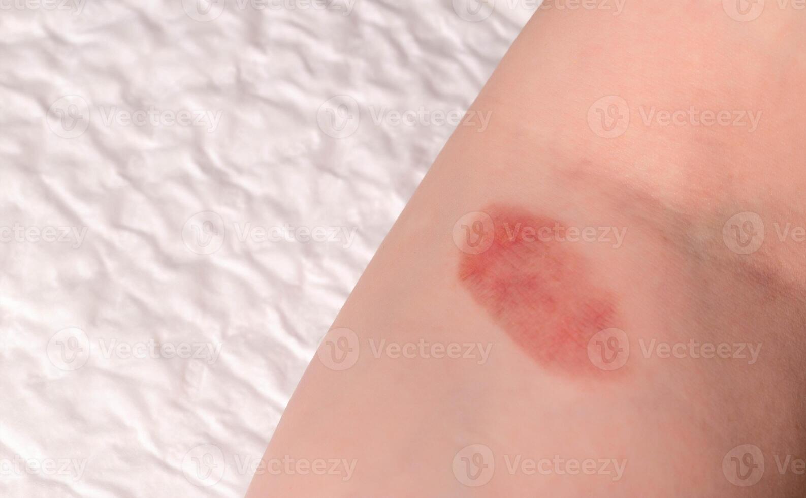 Red spot on the skin, skin damage from a burn on the arm. Copy space for text photo
