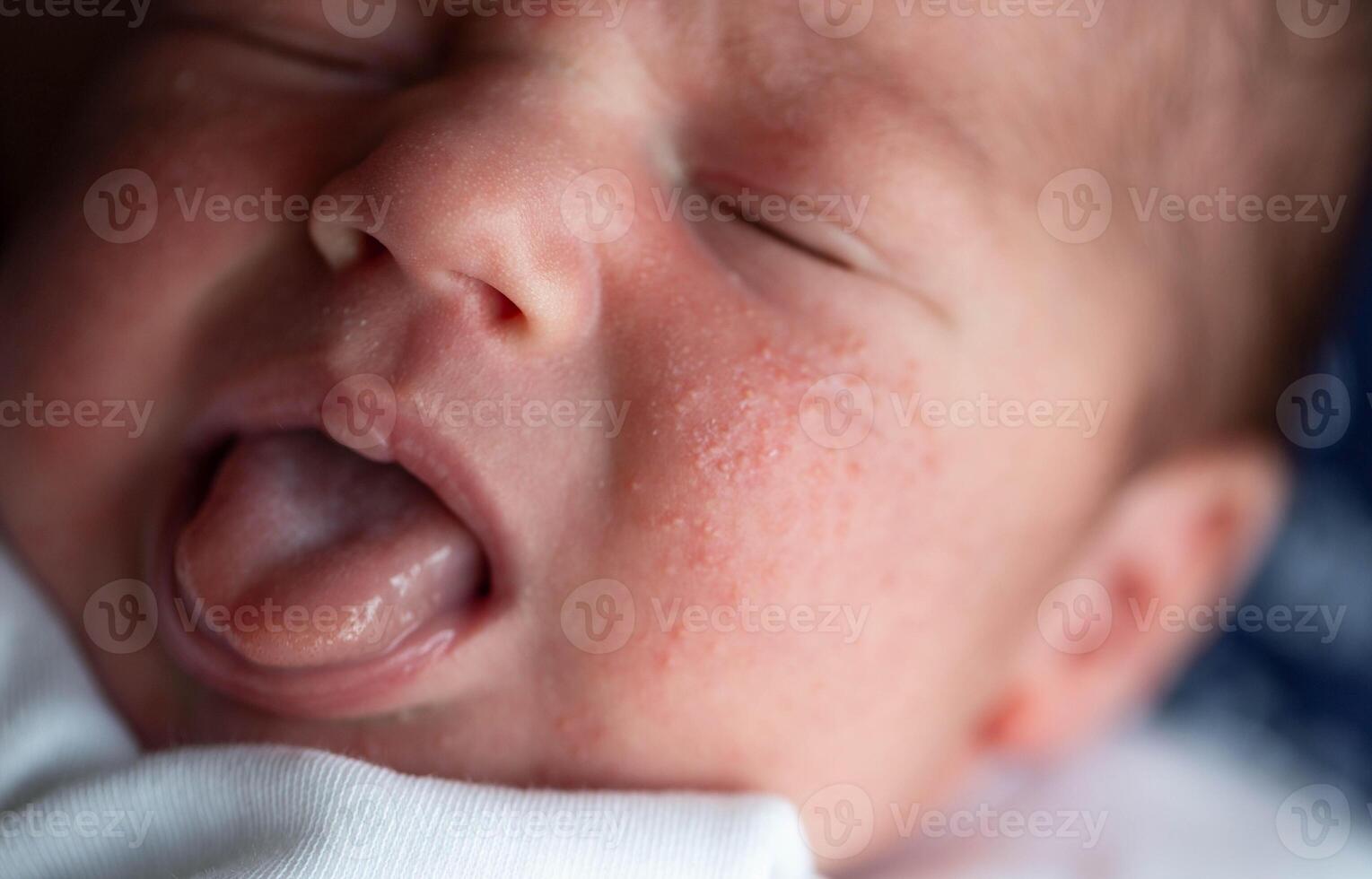 Pimples on the face of a newborn. Baby's adaptation to the environment, close-up photo