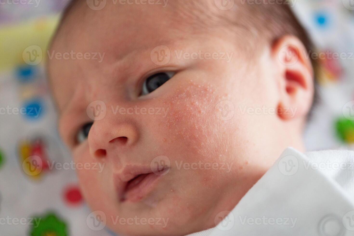 Pimples on the face of a newborn. Baby's adaptation to the environment, close-up photo