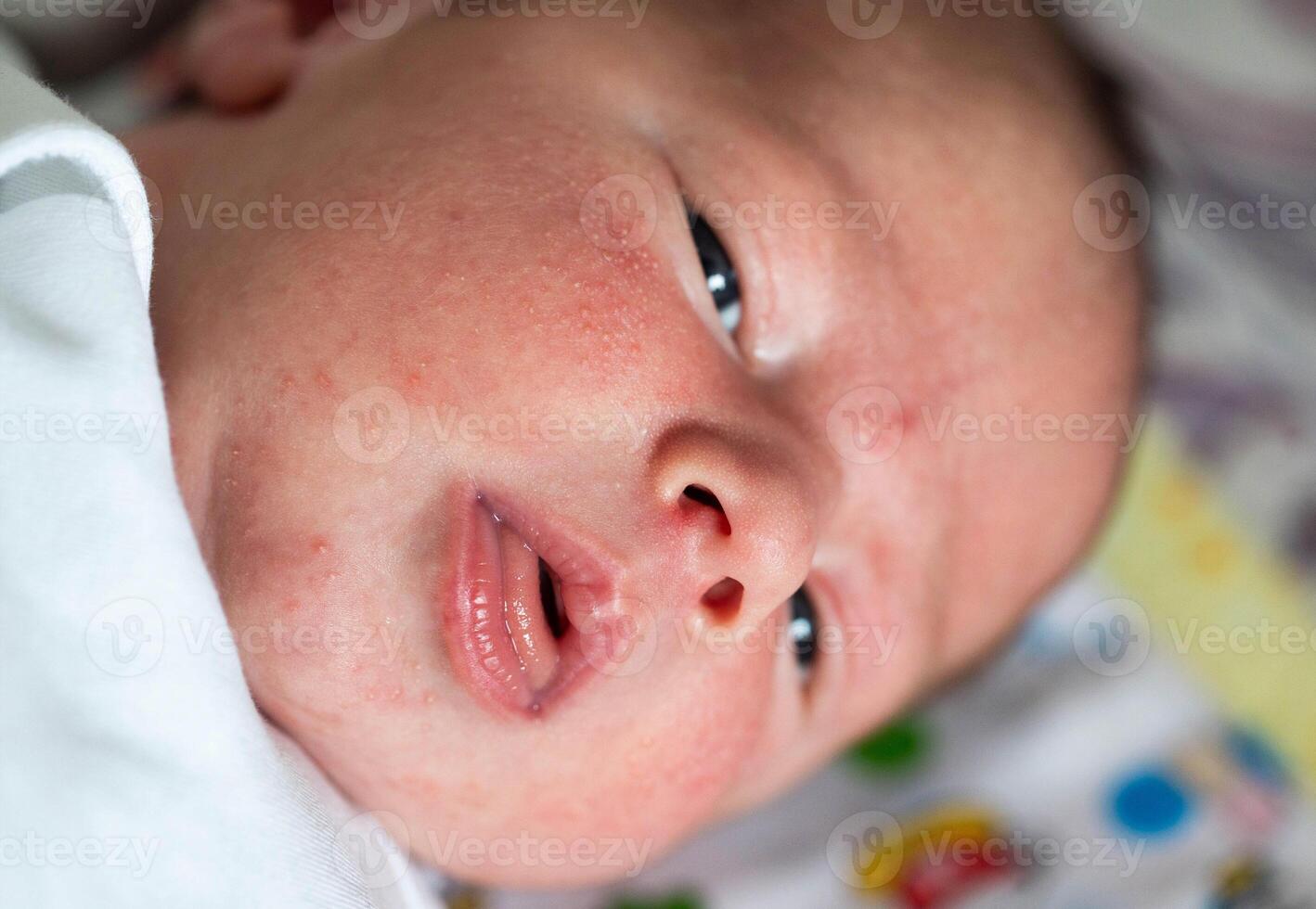 Rash on the face of a newborn baby. The process of formation of the hormonal system, close-up photo