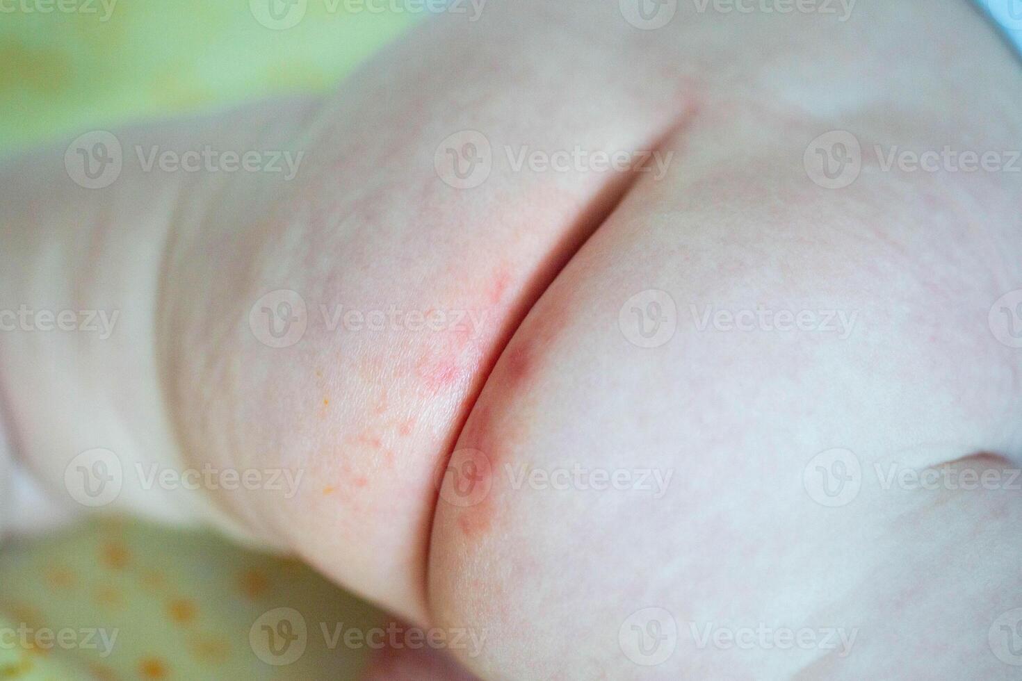 Red diaper rash on the pope of a baby from a diaper. Irritation on the delicate skin of an infant. Dermatitis photo