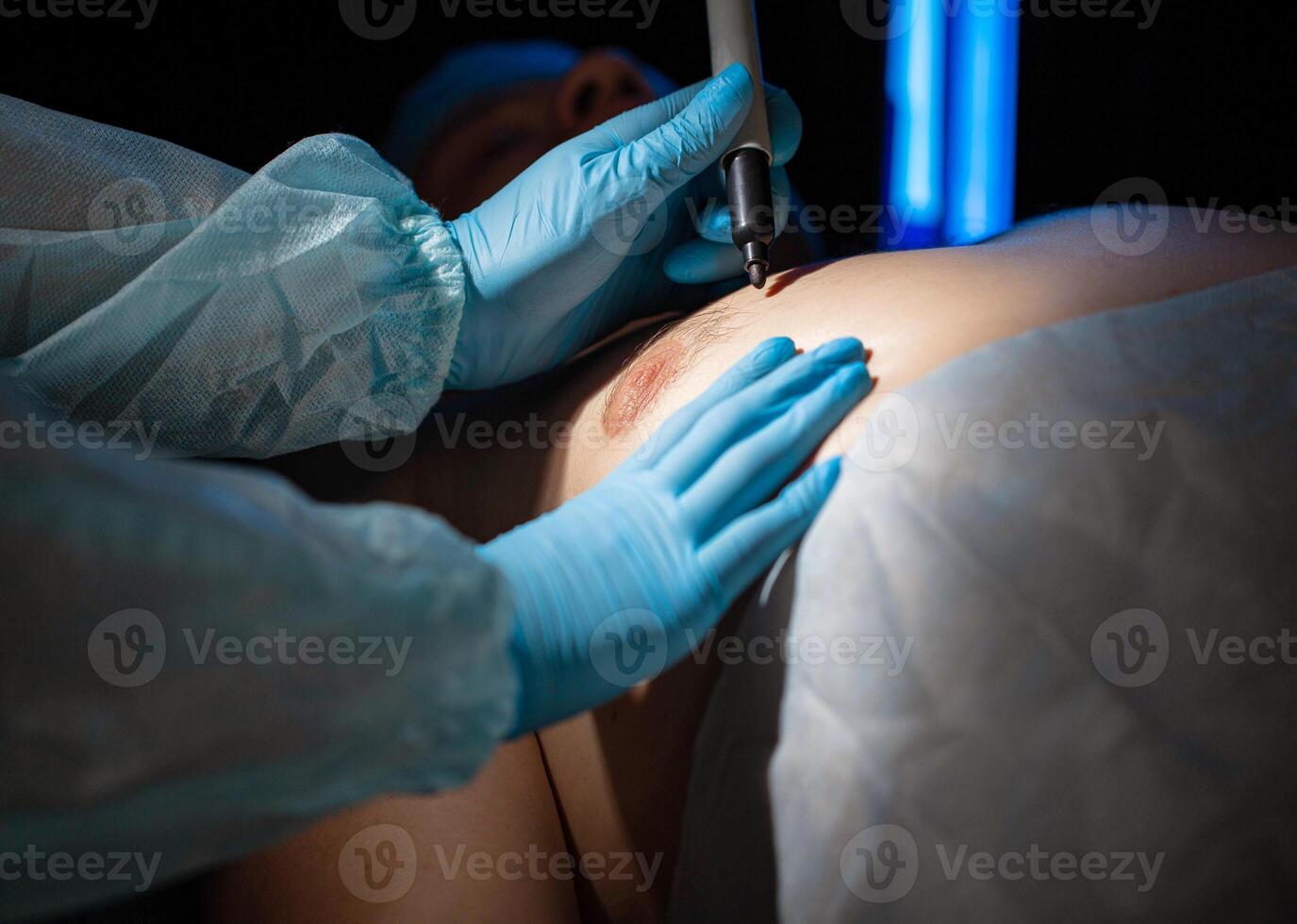 Plastic surgeon doctor prepares for breast reduction surgery on a man, close-up. Liposuction photo
