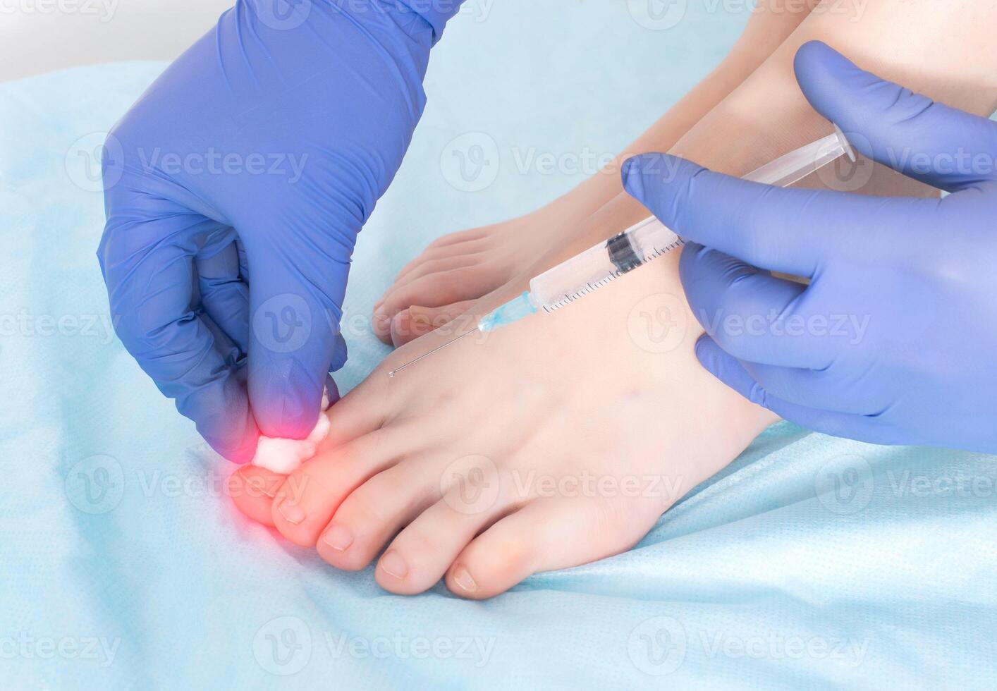 The doctor makes an injection in the joint of the toe for arthrosis, swelling and inflammation in the joint. Concept of joint regenerating injections with ozone-oxygen mixture, ozone therapy, modern photo