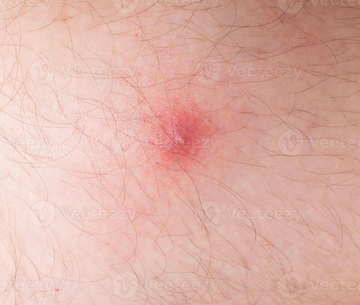 Red pimple on problem skin, close-up, background photo