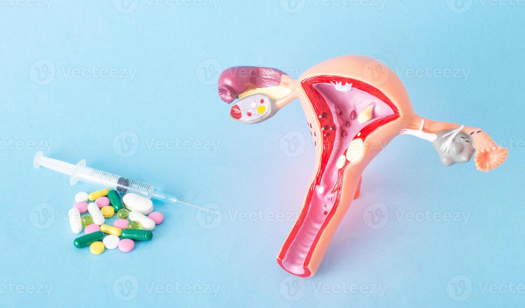 Mock up of the female reproductive system and a bunch of pills and injections on a blue background. Concept of drug treatment of genital infections, antibiotics, trichomoniasis photo