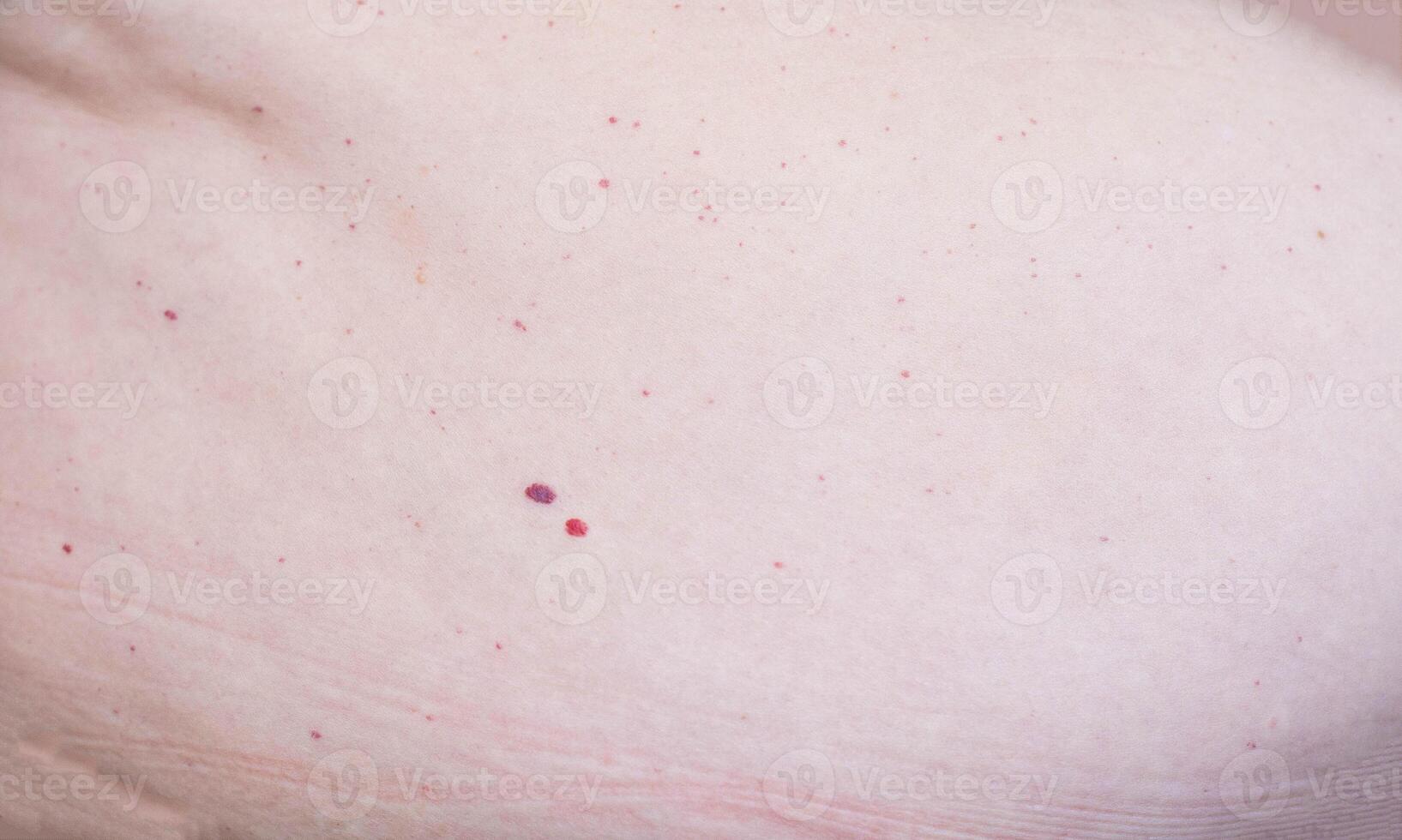 Red moles of nevi on the abdomen in humans, hemangioma photo