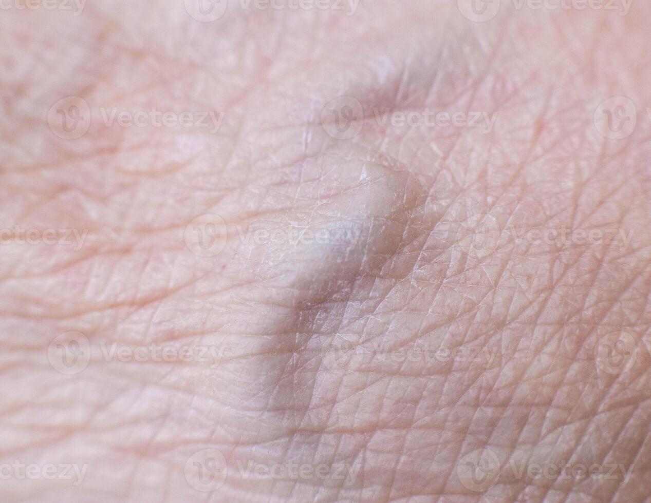 convex vein on the skin of a person, background. Varicose veins concept, macro photo