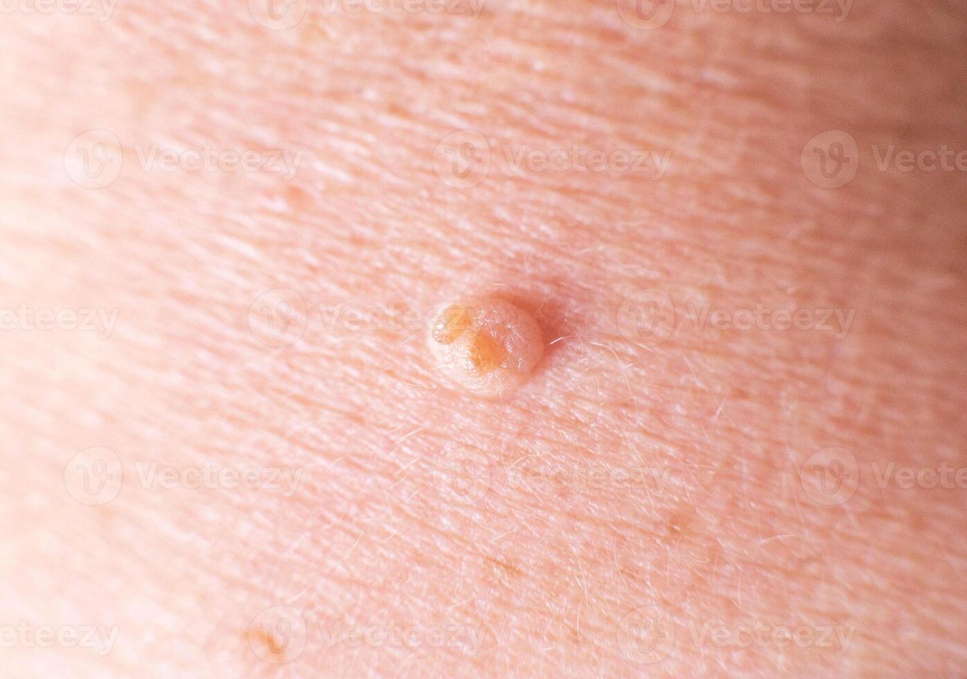 large wart on the skin of a person, background, macro, dermatology photo