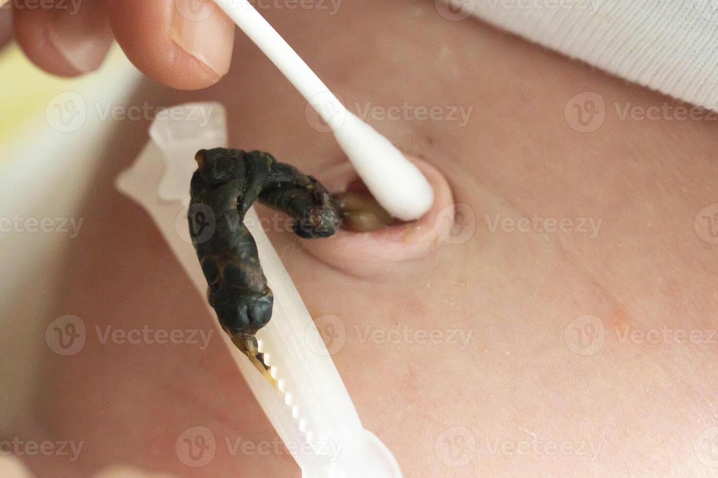 Treatment of the navel and umbilical cord of a newborn with hydrogen peroxide and a cotton swab to dry and heal the umbilical cord of an infant. Medical photo
