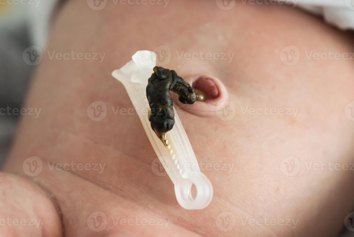 The remains of the umbilical cord in a baby after birth. Healing of the umbilical wound and umbilical ring, close-up. photo