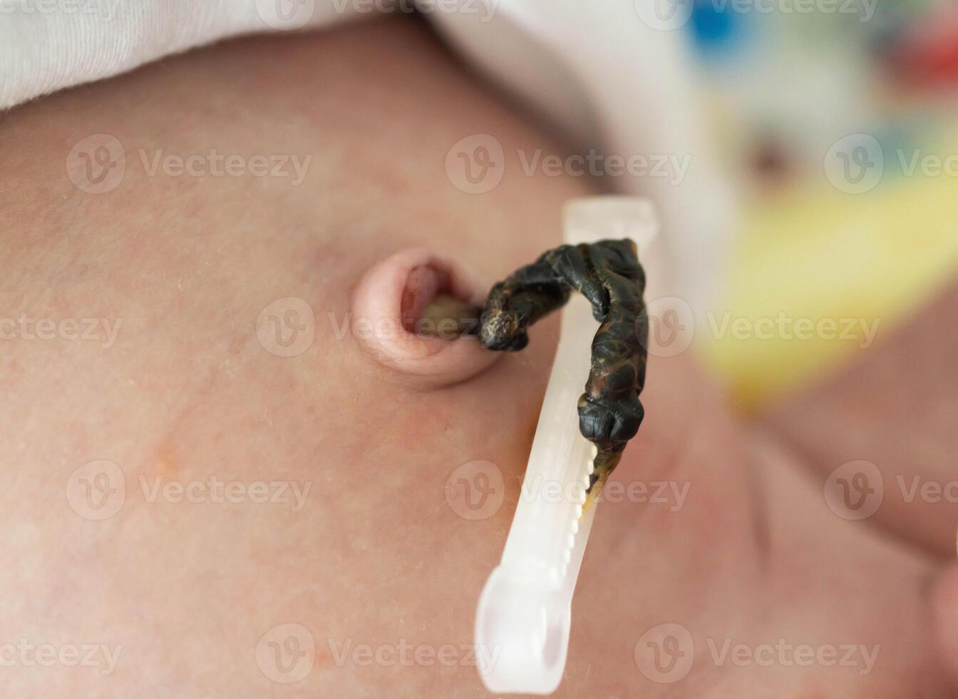 The remains of the umbilical cord in a baby after birth. Healing of the umbilical wound and umbilical ring, close-up. photo