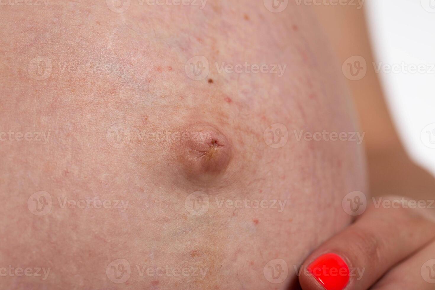 Convex navel on the stomach of a pregnant girl, close-up. Stretch marks on the skin, esthetic photo