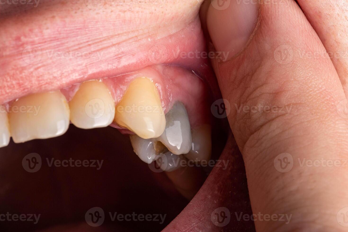 A black tooth in a man's mouth after removal of a nerve and filling of dental canals with low-quality materials. Tooth whitening, close-up photo