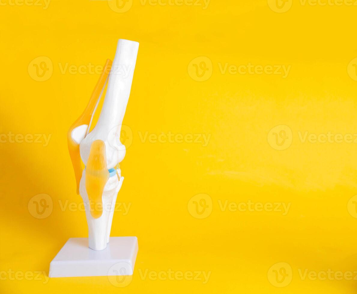 Knee joint mockup on yellow background. Concept of knee arthroplasty with implants. Copy space for text, replacement photo
