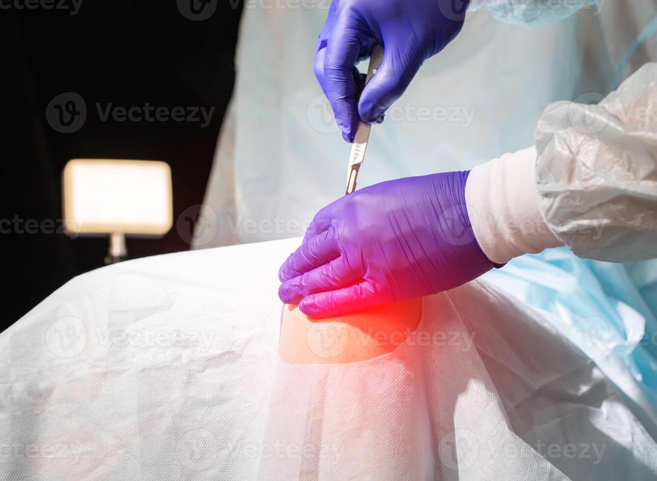 Doctor's hands with a scalpel near the patient's sore knee in the operating room. Knee replacement concept, arthroplasty photo