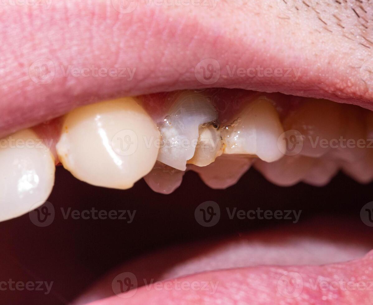 A black dead tooth in which a piece of tooth enamel is chipped off, a tooth chip. The concept of dental restoration in modern dentistry, macro photo