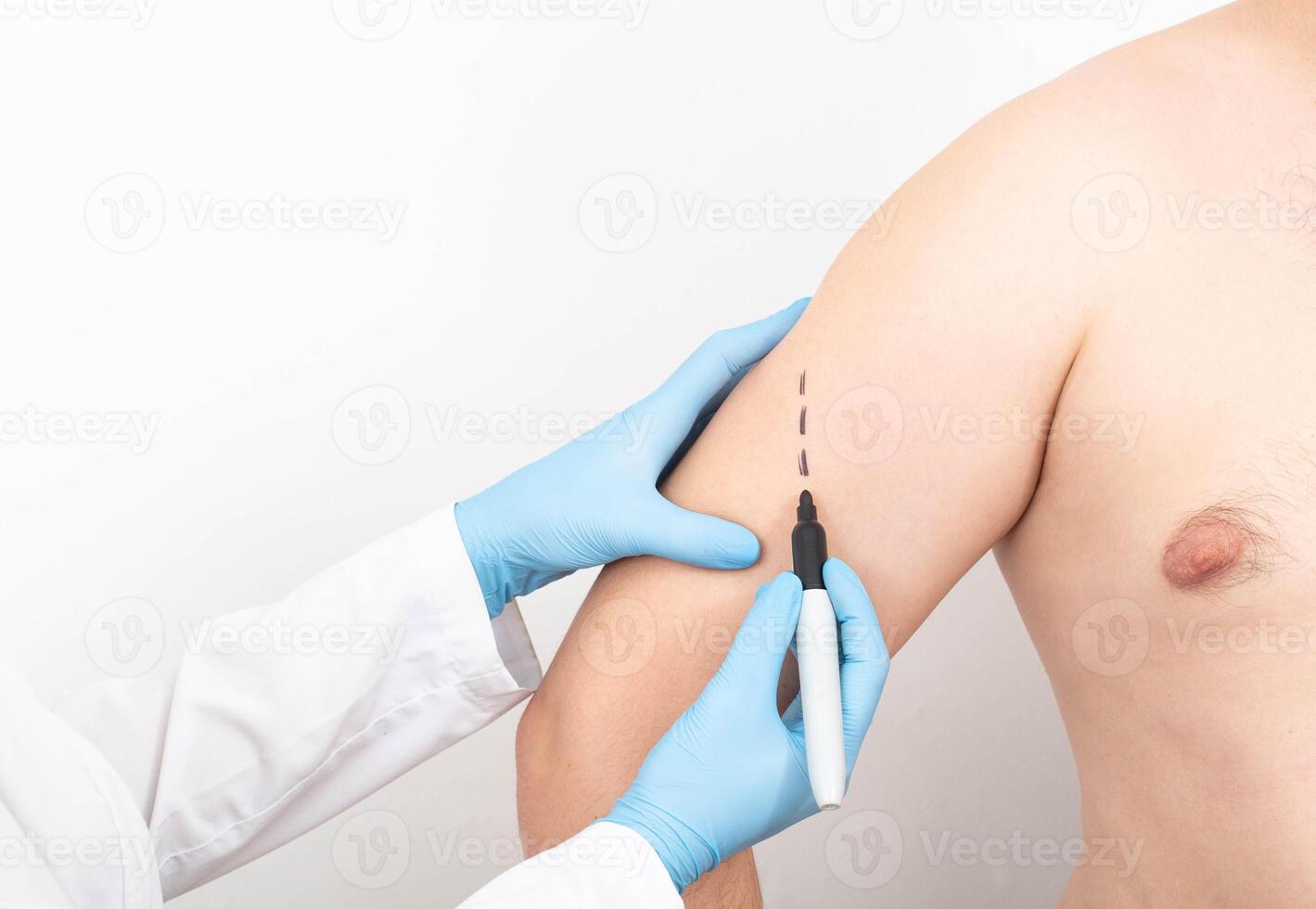 The doctor marks the place on the arm with a marker for the operation to increase the triceps and biceps using an implant. Copy space for text photo