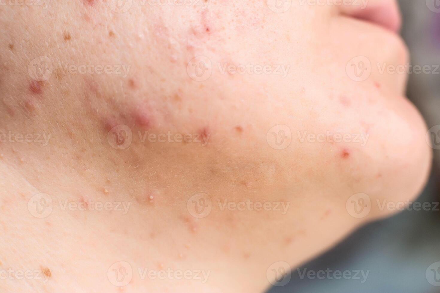 Red acne and a rash on a girl's face and neck, macro, hormone photo