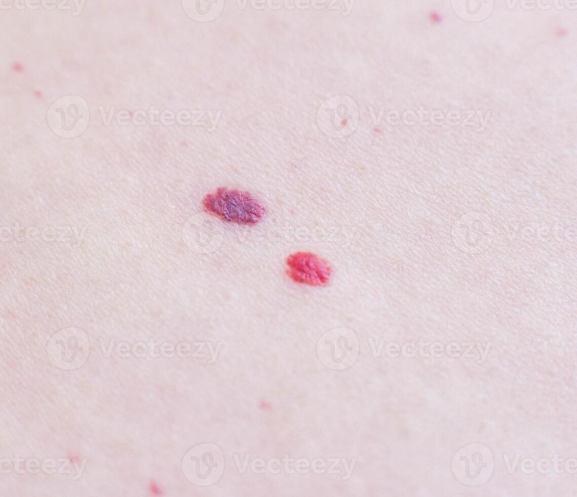 Two red moles on the patient s skin, hemangioma, macro, angioneuromas photo