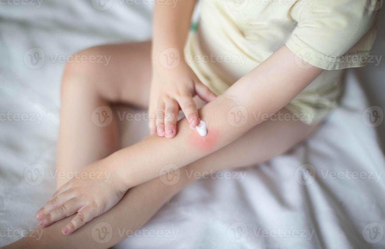 A small child smears redness on the hand with baby cream. The concept of treatment and skin care with a cream, rash and peeling in children, dermatology photo