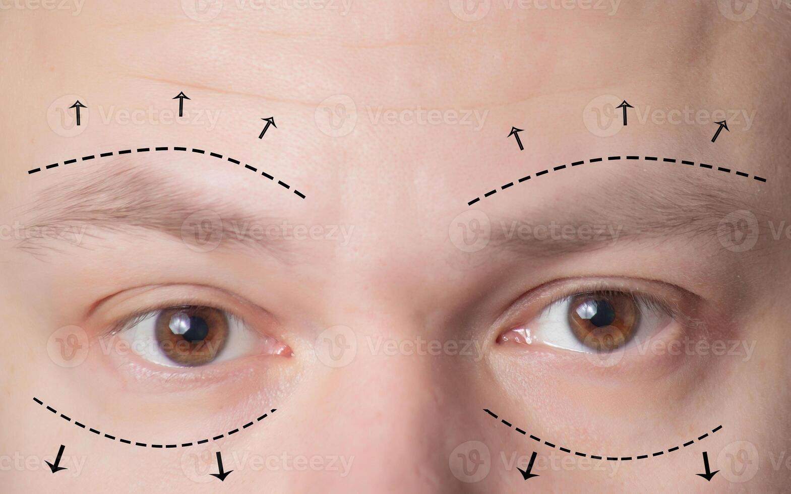 Plastic surgery of eyebrows in men, lower and upper eyelids. The concept of the modern blepharoplasty procedure, lifting, close-up photo