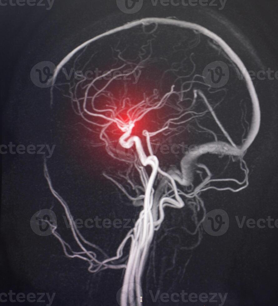 MRI image of a brain vessel. The concept of cerebrovascular disease, stroke and circulatory disorders, atherosclerosis photo