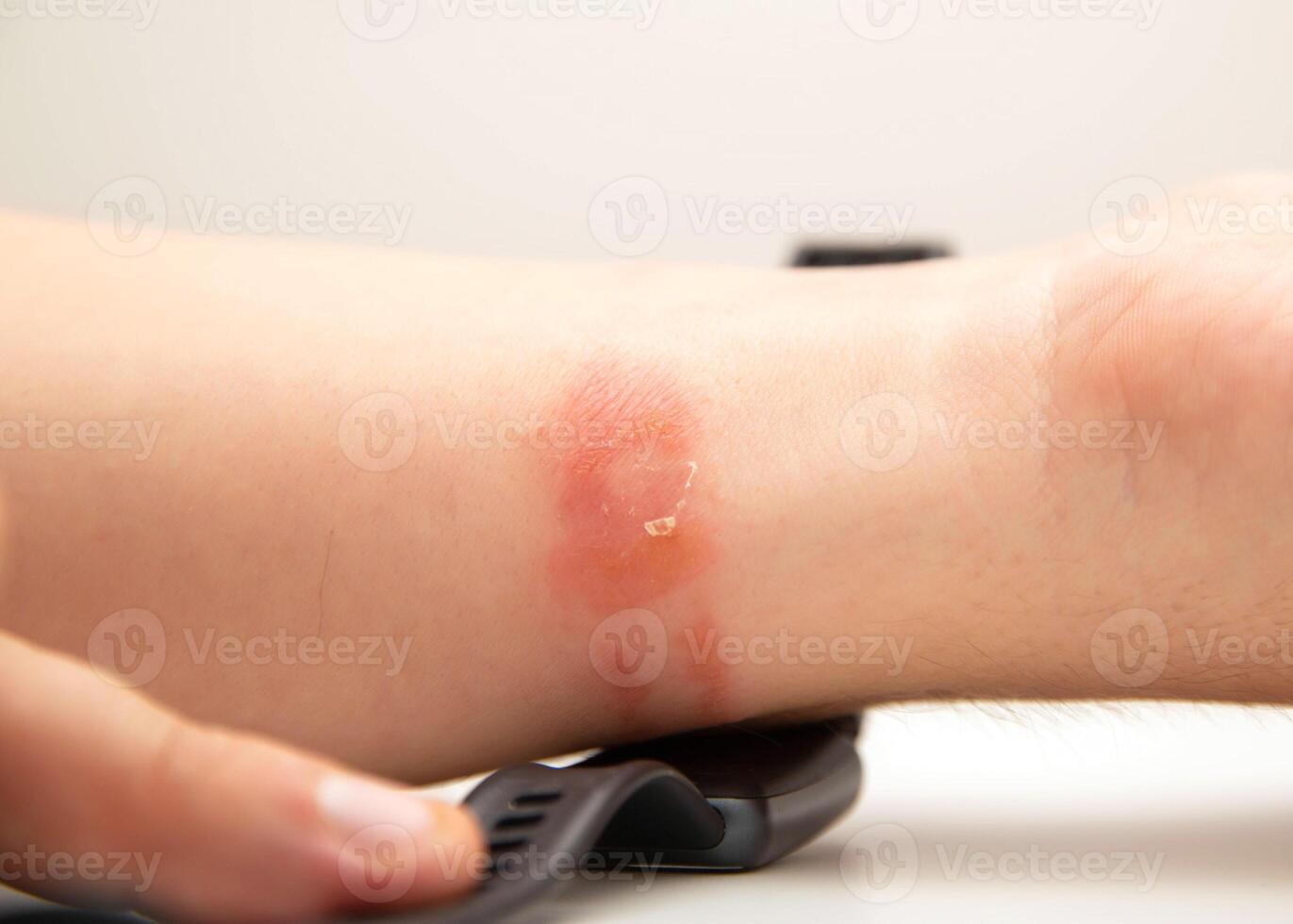 Irritation, redness and itching on the skin after wearing a watch or fitness bracelet. Allergy to watch strap, contact dermatitis, close-up photo
