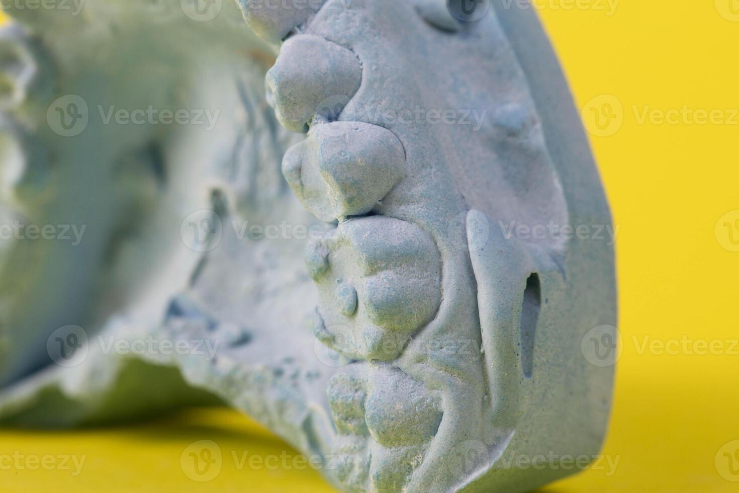 Blue plaster impression of a patient's dental jaw with crooked teeth and malocclusions on a yellow background. Manufacturing of bridges, crowns of various types, macro, arrangement of teeth photo