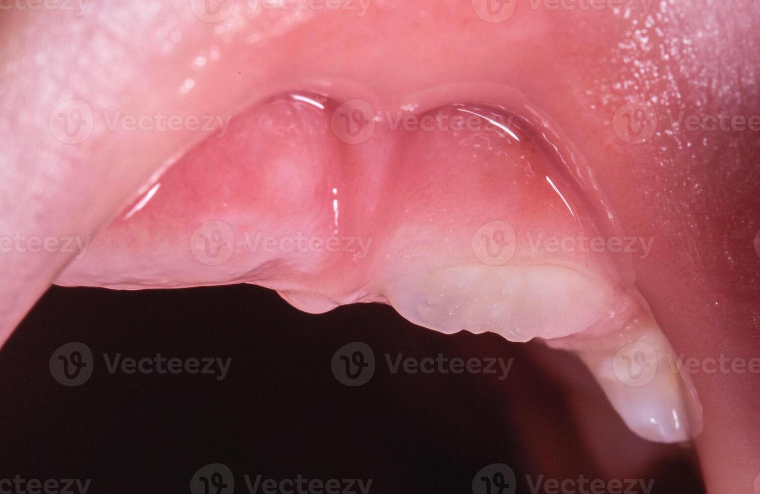 Swelling of the gums during the eruption of permanent teeth after the loss of milk teeth in children. Children's dentistry. Close-up photo