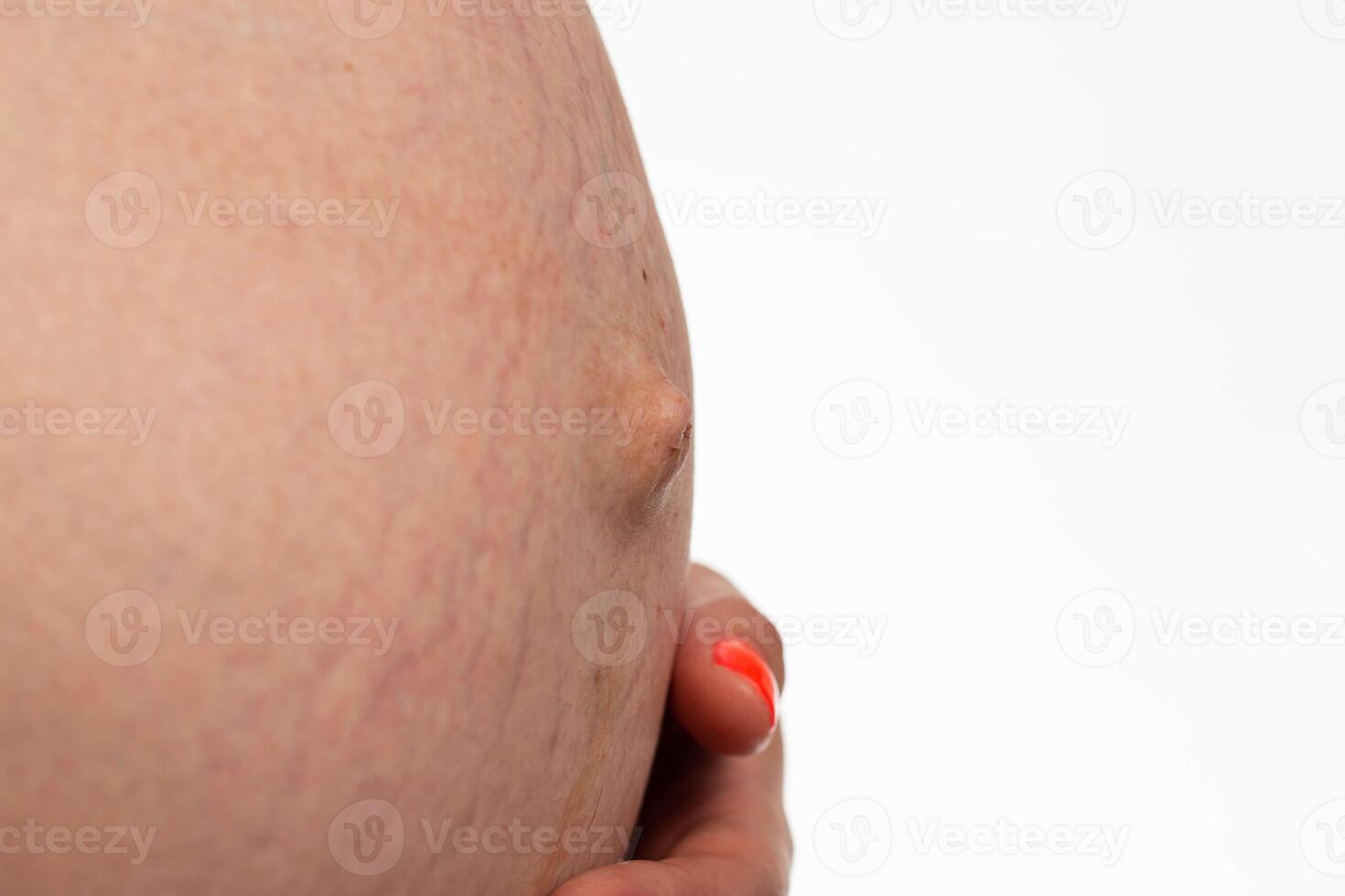 Stretch marks on the abdomen of a pregnant girl, a bulging navel. Cosmetic defect on the skin during pregnancy, naturalness photo
